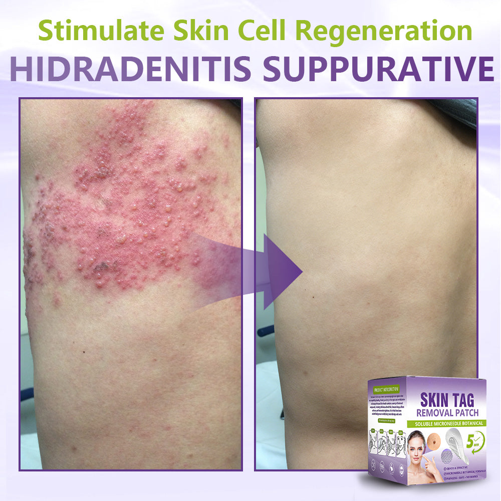 SOLUBLE MICRONEEDLE BOTANICAL SKIN TAG REMOVAL PATCH-$LA