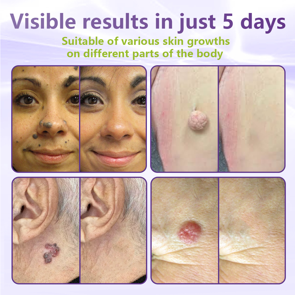 SOLUBLE MICRONEEDLE BOTANICAL SKIN TAG REMOVAL PATCH-$LA