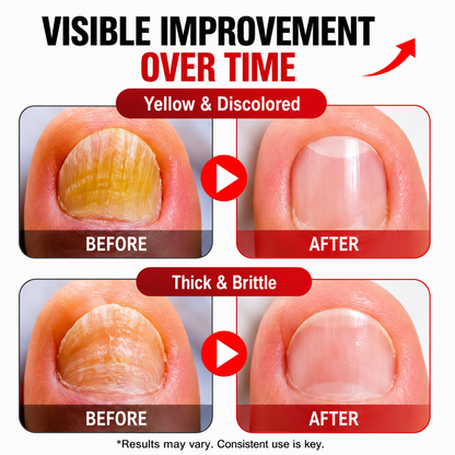 Toenail Fungus Treatment Extra Strengthr-CJ