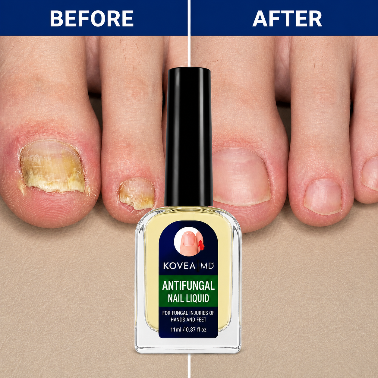 💅✨Clear Fungus Nails & Restore Healthy Clear Nails in Just 14 Days! -$AC