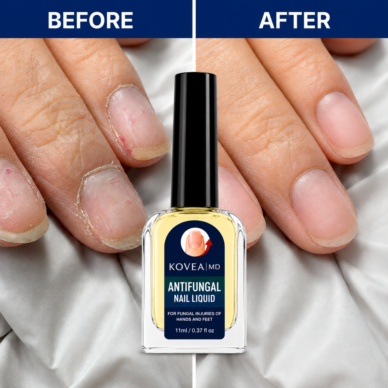 💅✨Clear Fungus Nails & Restore Healthy Clear Nails in Just 14 Days! -$AC